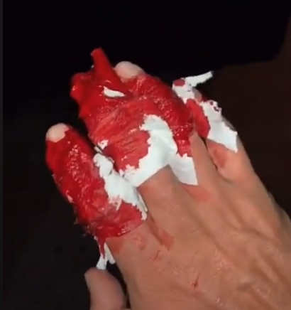 The calum von moger injury in action, he ends up getting 26 stitches.